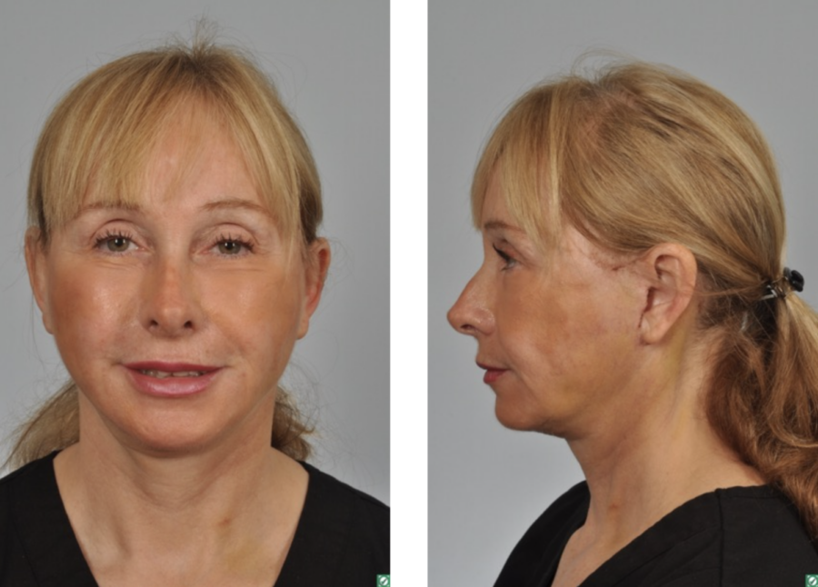 woman 2 weeks after face and neck lift